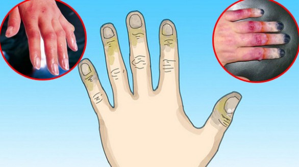 Cách chữa trị cho người bị bỏng lạnh
