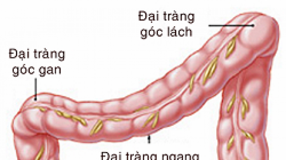 Phòng tránh bệnh ung thư trực tràng