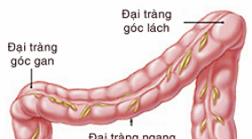 Phòng tránh bệnh ung thư trực tràng
