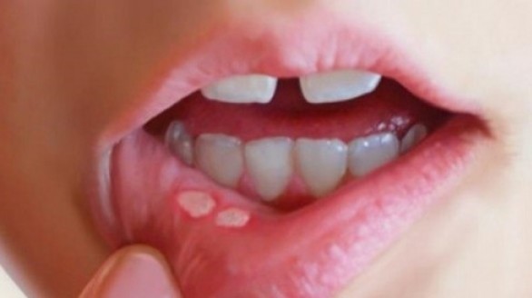 Loại lá cây chữa dứt nhiệt miệng chỉ sau một ngày sử dụng