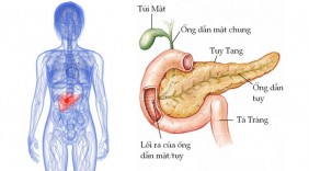 Những dấu hiệu của căn bệnh đáng sợ: Ung thư tuyến tụy